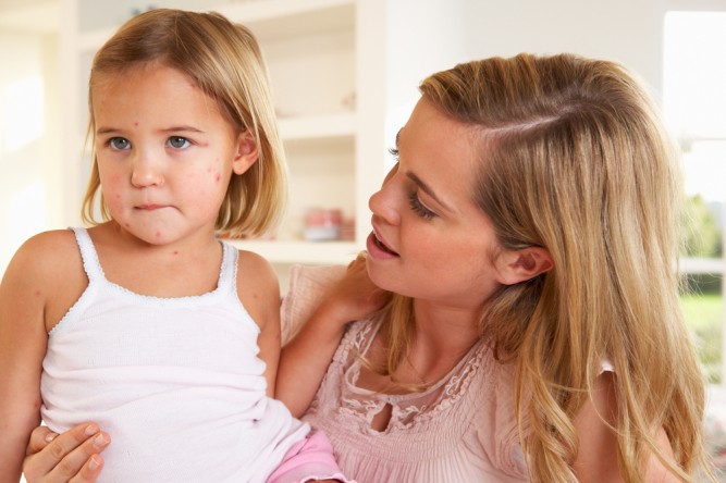 varicela