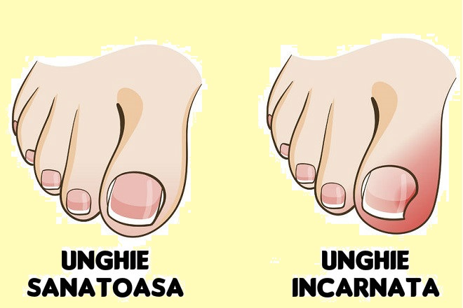 Este unghia încarnată o ciupercă? cresc unghiile de la picioare cu ciuperci