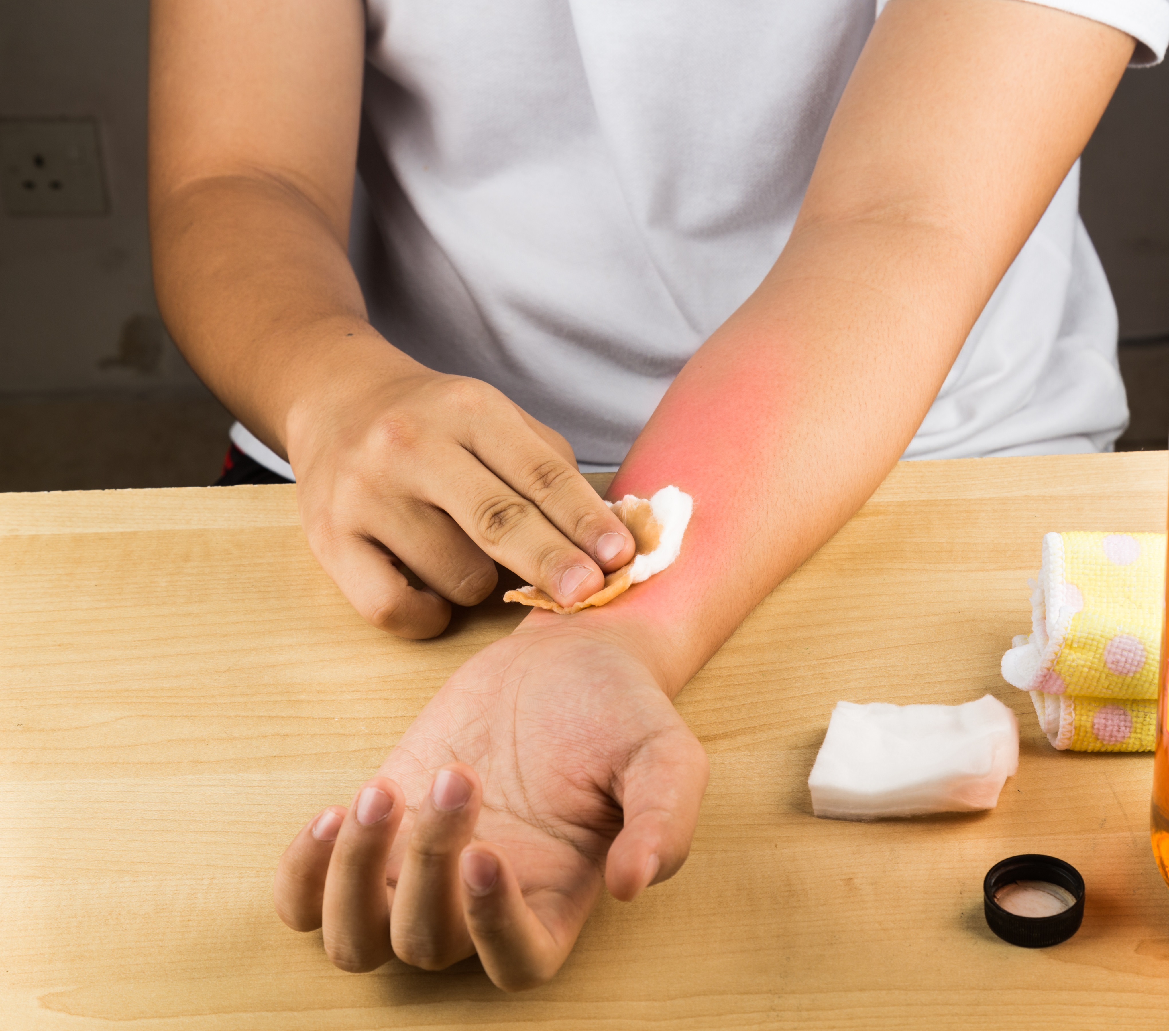 ожог уксусом помощь