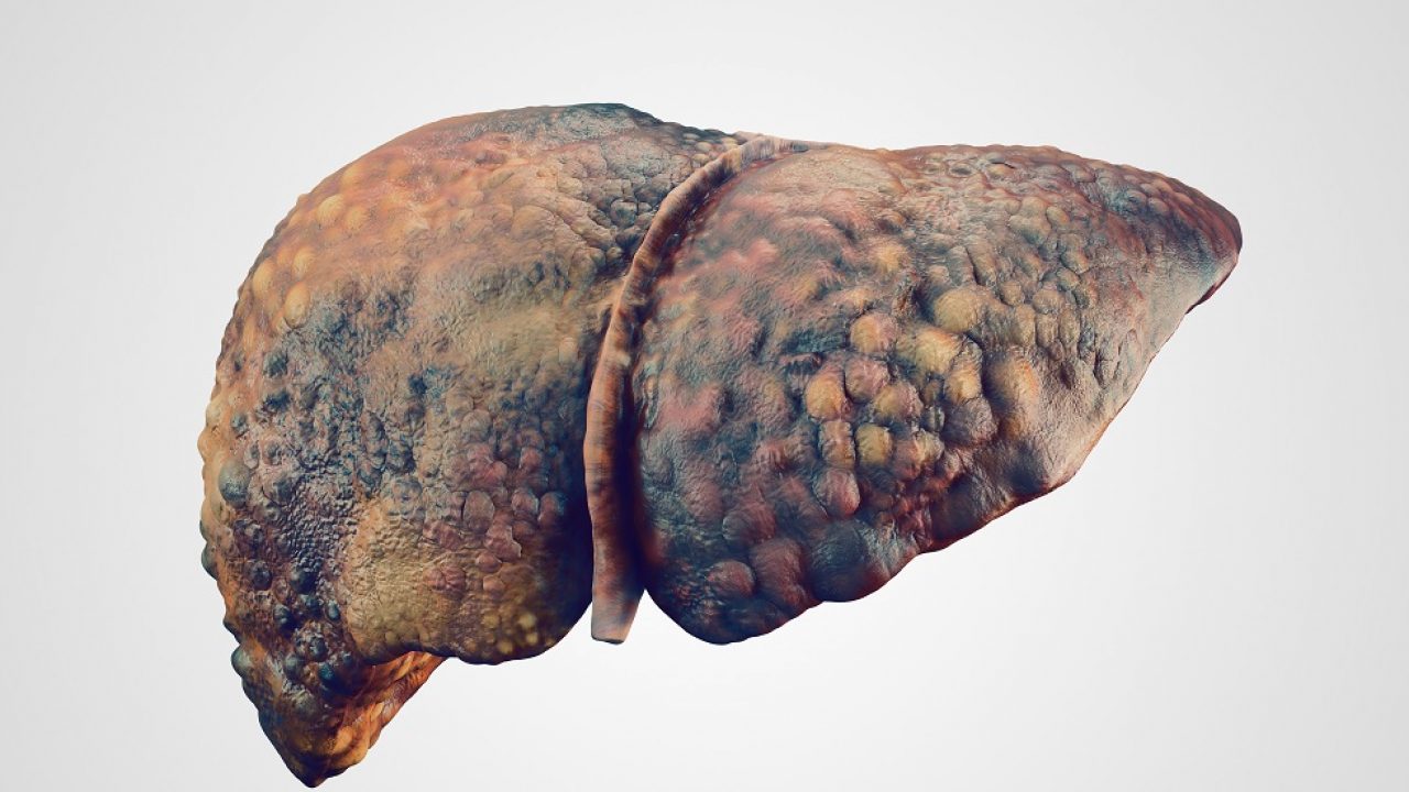 Carcinomul hepatocelular