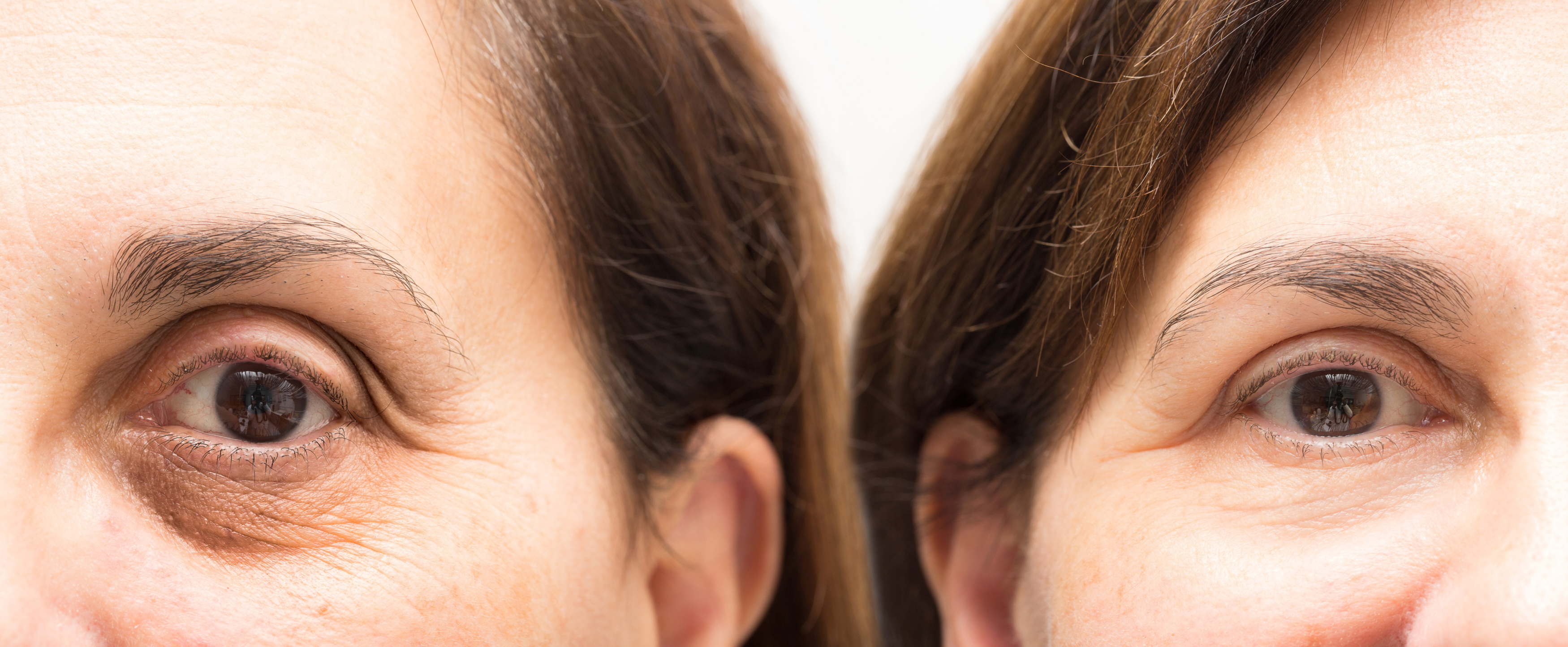 Tratamente pentru pielea din jurul ochilor - Doza de Sănătate