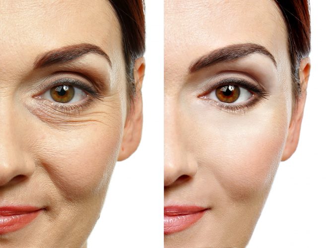 cum să îndepărtezi o ridă adâncă de pe frunte chalet grange neuve suisse anti aging