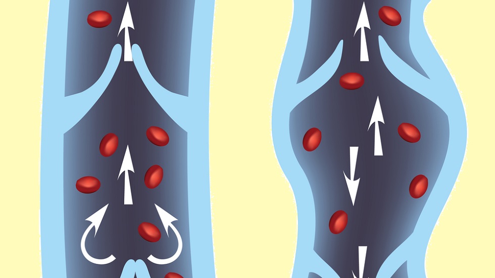 20 de ani de vene varicoase ce sa faca