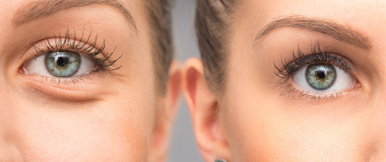 10 remedii simple și eficiente pentru pungile de sub ochi - Ioana Cosmetice