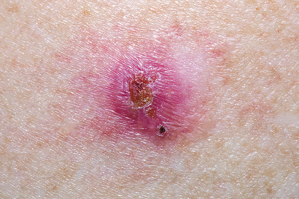 Cancer de piele