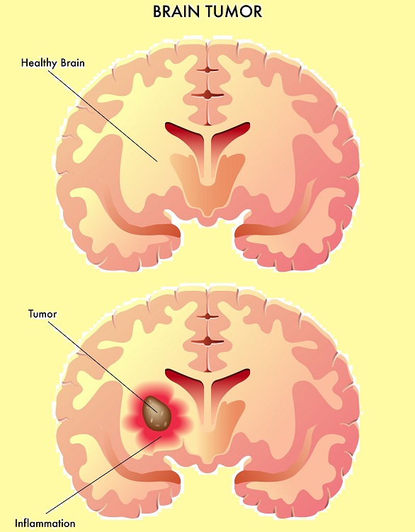 ce este meningiomul