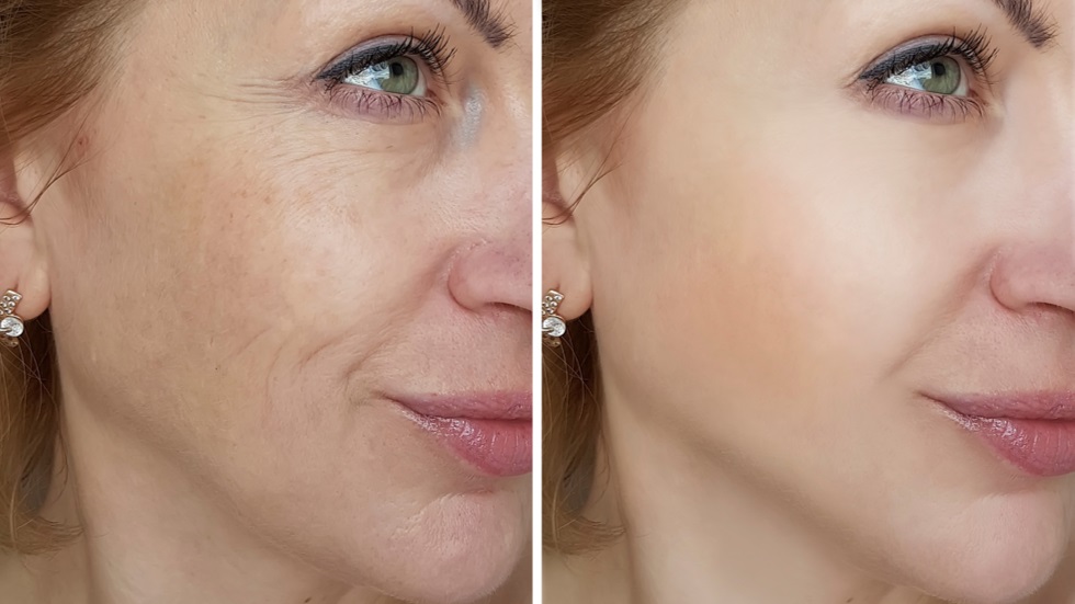 cremele pot elimina ridurile stoparea ridurilor
