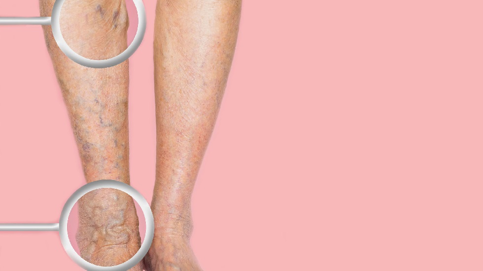 exerciiul varicos sticla medicala din varicoza