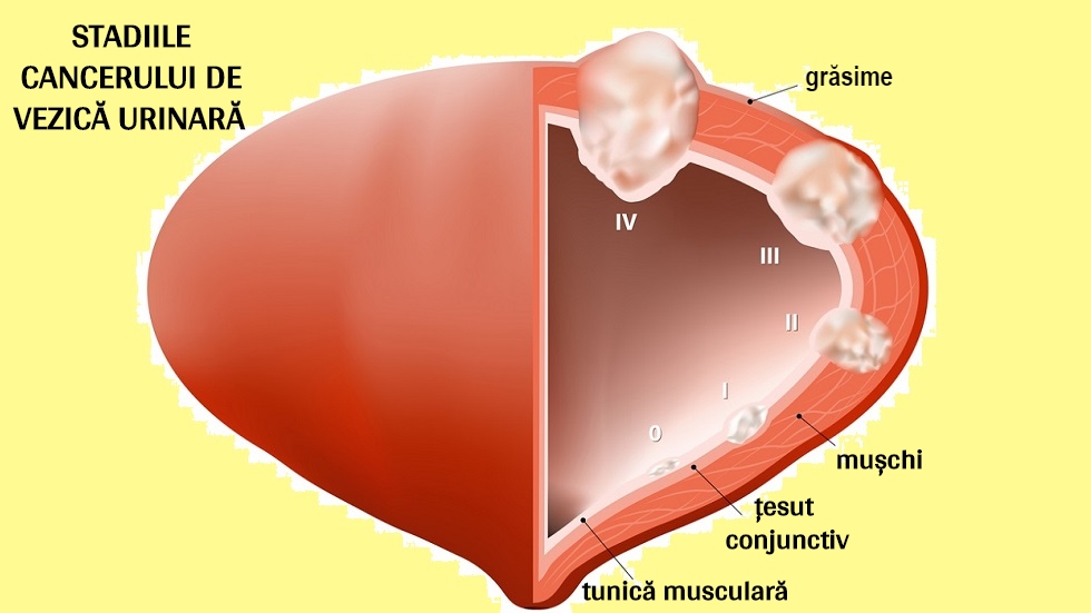 cistectomie vezica urinara)