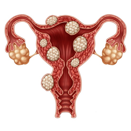 endometrioza